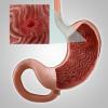 Zapalenie błony śluzowej żołądka lub erozja żołądka: główne objawy, leczenie, dieta