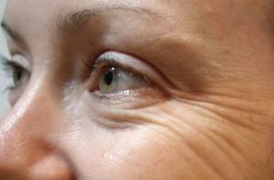 Jak zapobiegać powstawaniu zmarszczek wokół oczu
