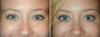 Jaka kombinacja zabiegów kosmetycznych będzie bombichesky wpływ na twojej twarzy
