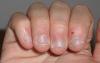 Jak oduczyć gryząc paznokcie?