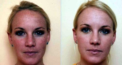 Peeling węgla. Zdjęcia przed i po. Pacjent ma tłustą rodzaju skóry.