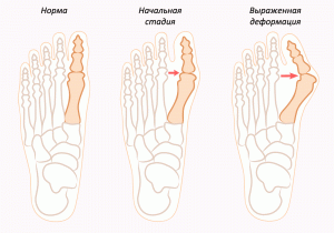 Jak usunąć kość w stopie