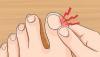 Jak pozbyć się grzybicy paznokci w domu