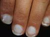 Dlaczego wybielić paznokcie