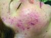 Efekty uboczne lasera, zastrzyków kosmetycznych, tatuażu i microbladingu