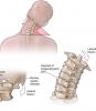 4 podstawowe ćwiczenia dla kręgosłupa szyjnego pomoże zapomnieć o bólu i osteochondroza!