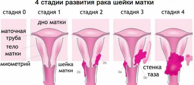 4 etapy z rakiem szyjki macicy